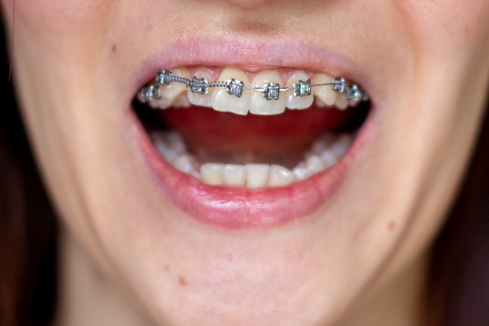 dental crowding treatment turkey