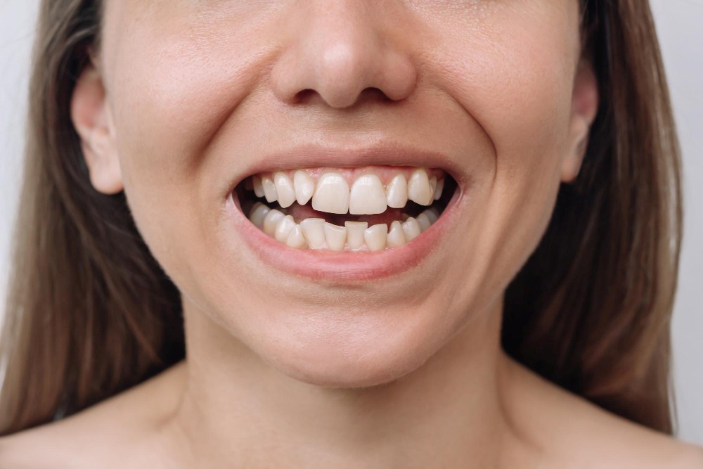 Dental Crowding: Severity and Orthodontic Solutions