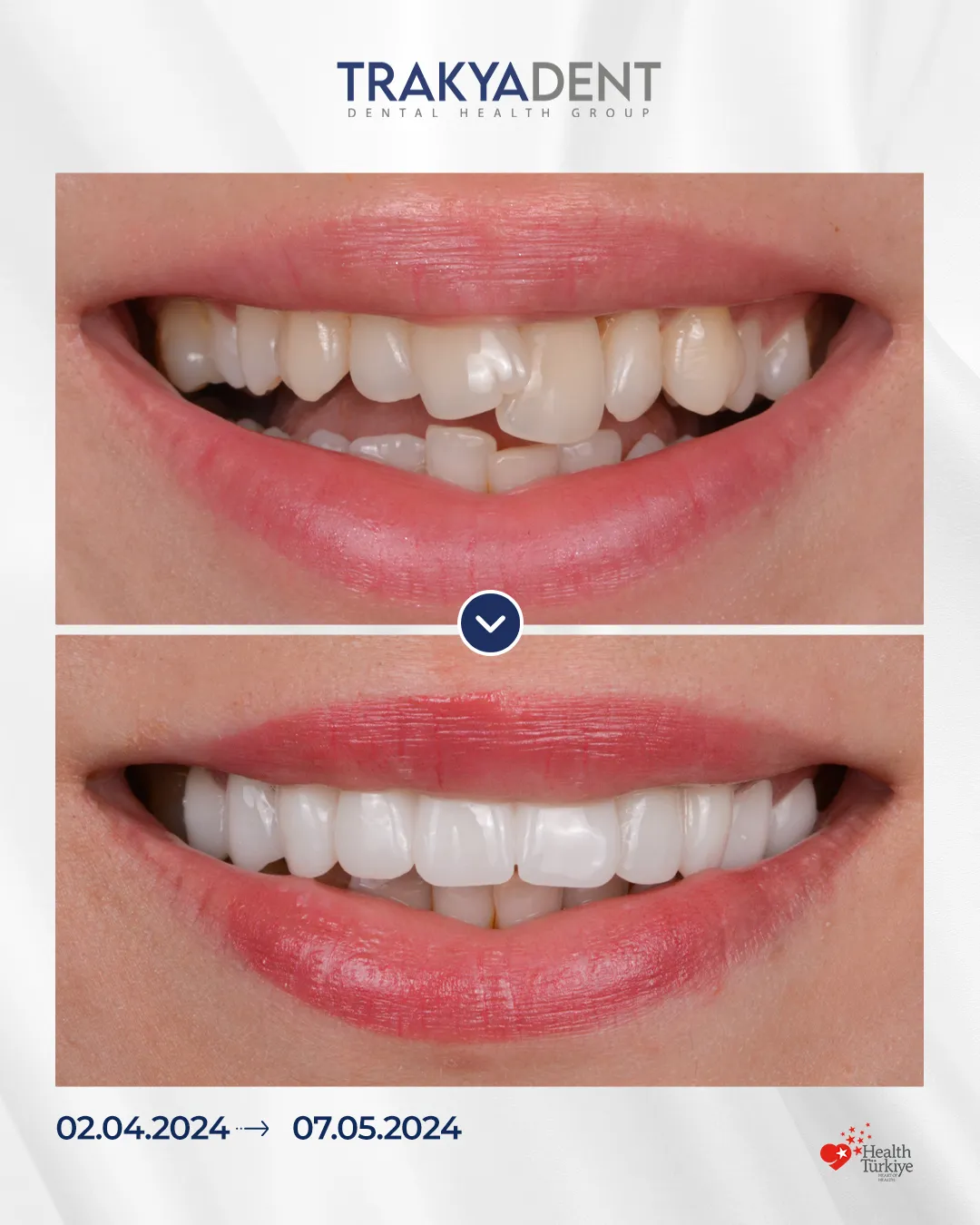 Laminate VeneersBefroeAfter-Trakyadent