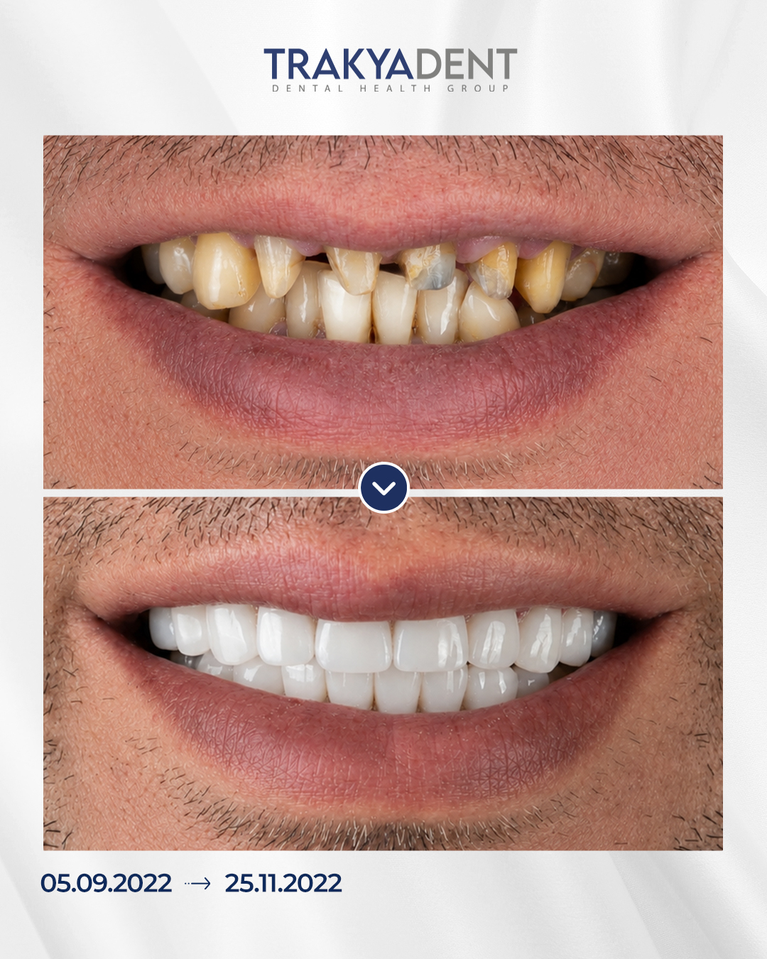 Premium Zirconia Crowns 